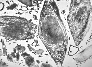 bone marrow … plasmocytoma (parafin-embedded sample) bone marrow … plasmocytoma (parafin-embedded sample)